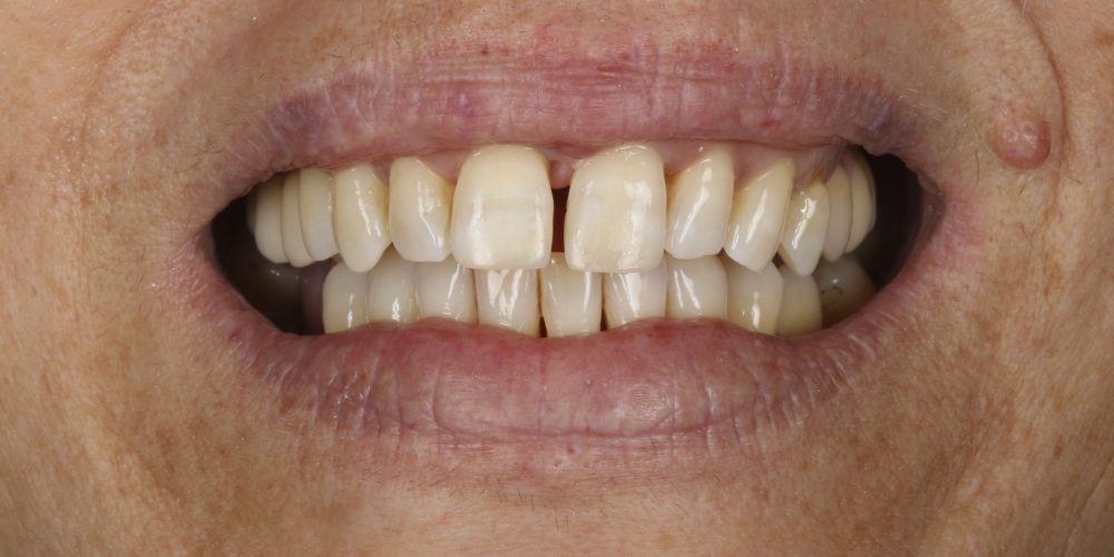LCR_11&21_frontal_final_1