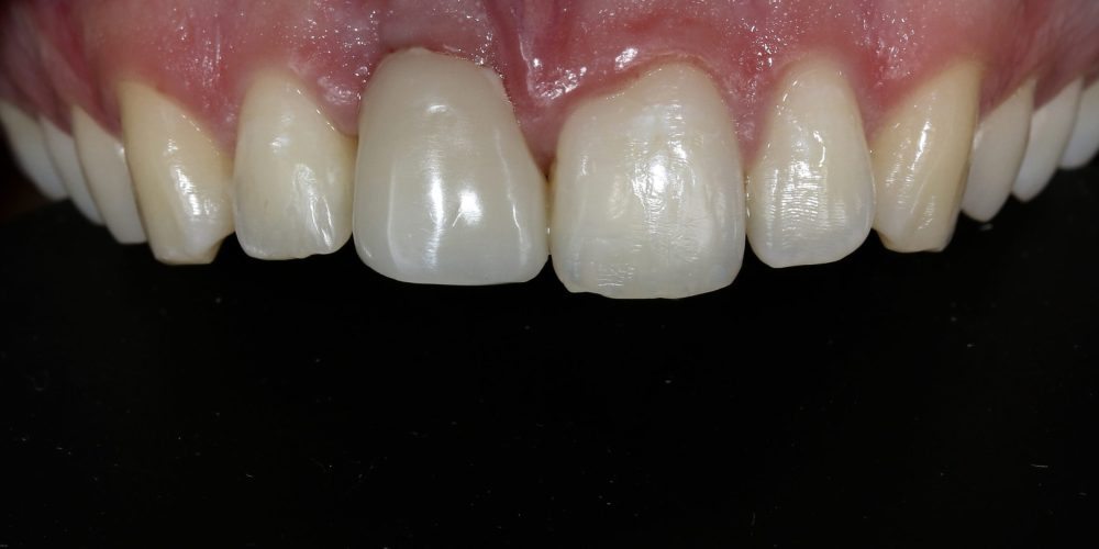 MAM_#11_intra-oral_superior_frontal_inicial copiar